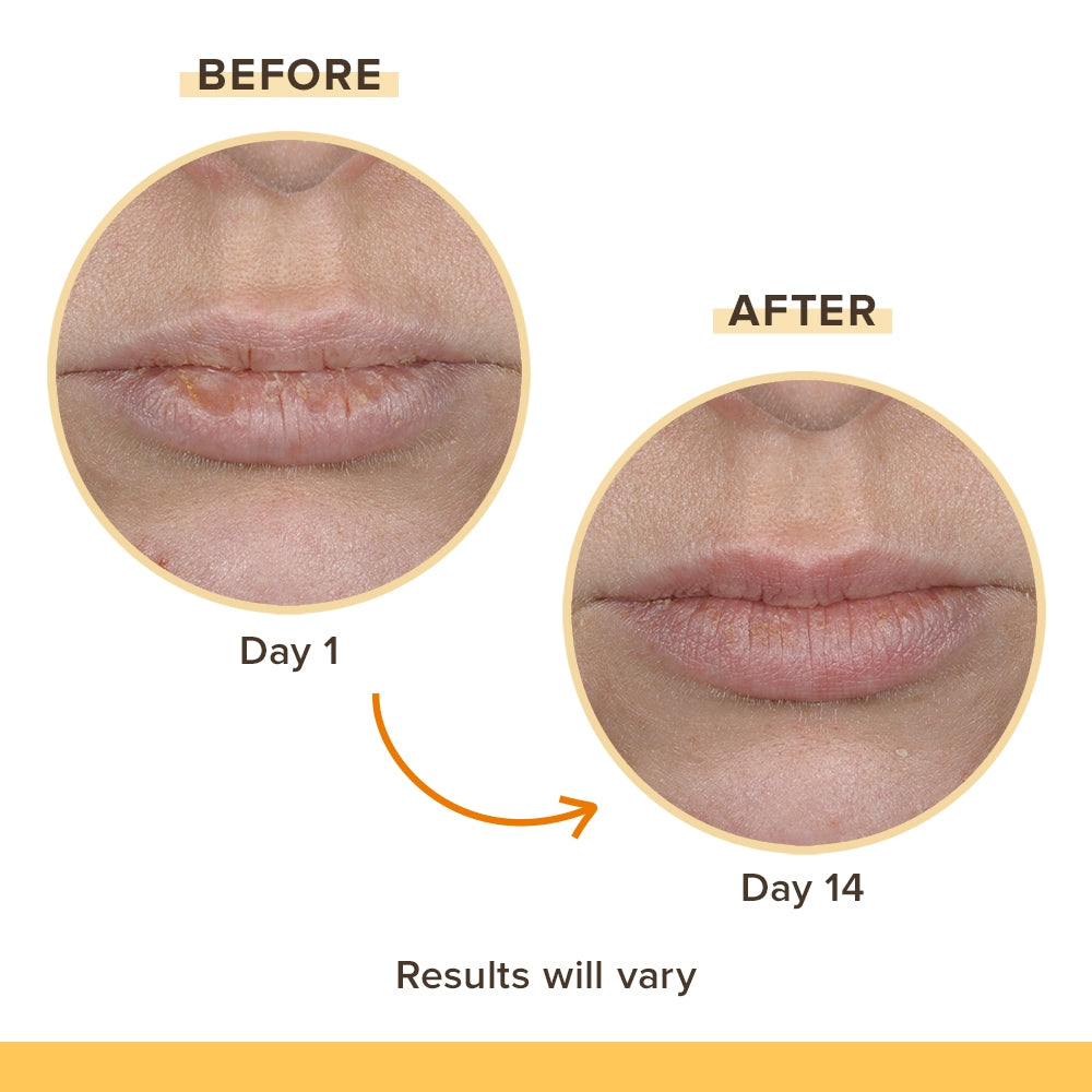 Lip Balm Rescue 4 Pack H2